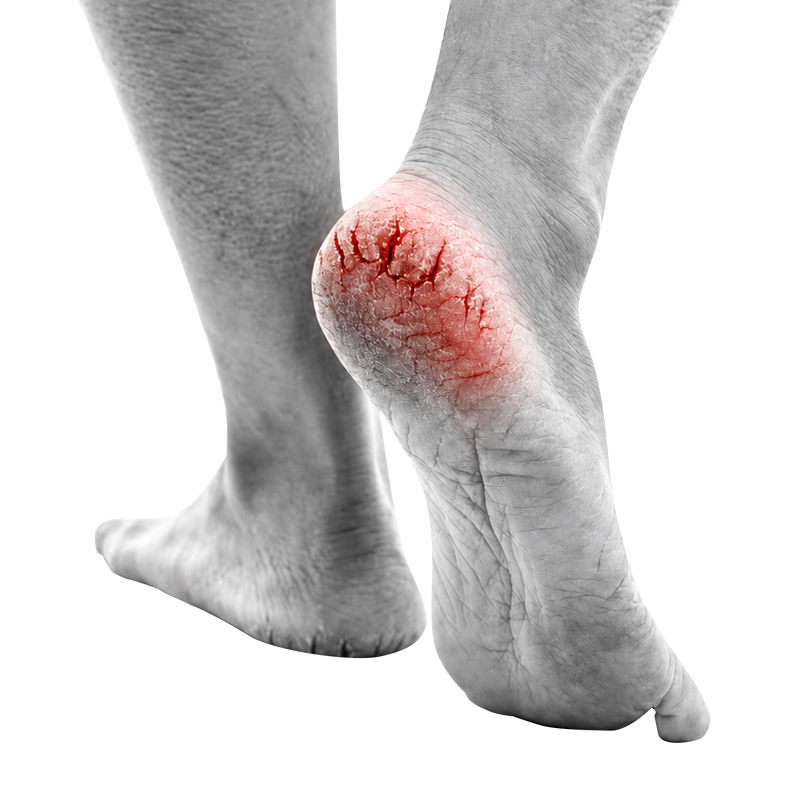Dry & Cracked Feet